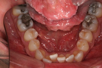 Invisalign