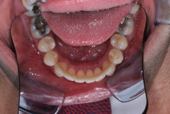 Invisalign