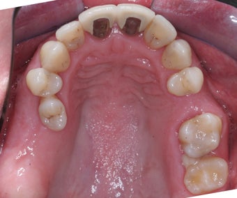 Invisalign, implants, whiteing and veneers