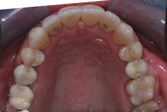 Invisalign, implants, whiteing and veneers