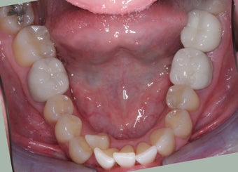 Invisalign