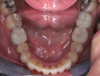 Invisalign