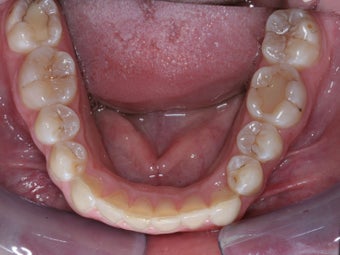 Invisalign