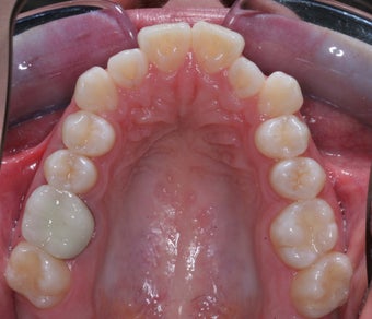 Invisalign