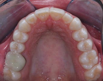 Invisalign