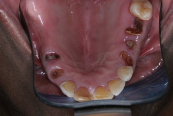 Smile makeover