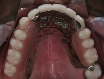 Smile makeover