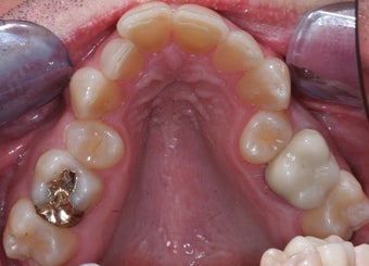 Smile makeover with Invisalign and Crowns
