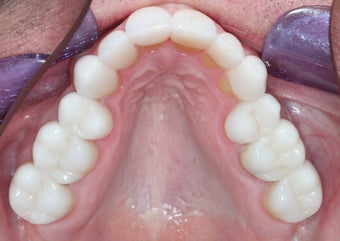 Smile makeover with Invisalign and Crowns