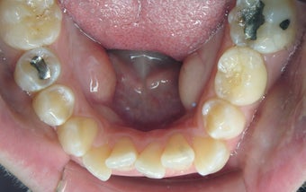 Invisalign