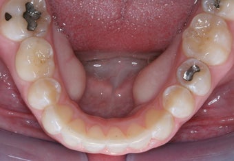 Invisalign