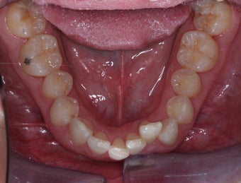 Invisalign