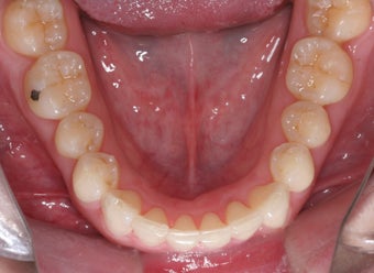 Invisalign
