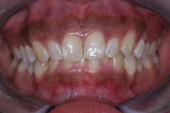 Invisalign
