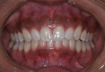 Invisalign