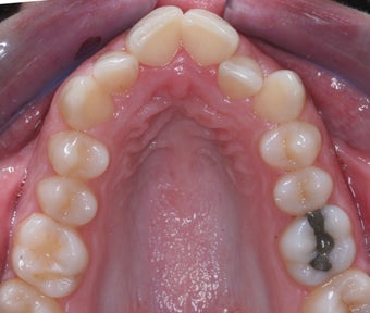 Invisalign