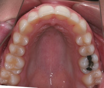 Invisalign