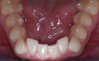 Invisalign