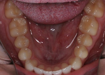 Invisalign