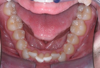 Invisalign