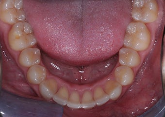 Invisalign