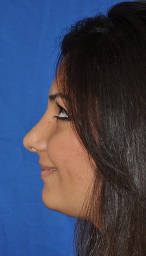 Rhinoplasty