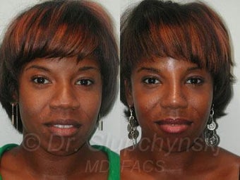 African American Rhinoplasty