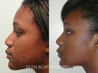 African American Rhinoplasty