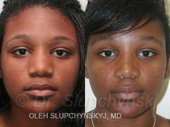 African American Rhinoplasty