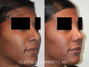 African American Rhinoplasty