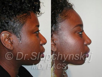 African American Rhinoplasty