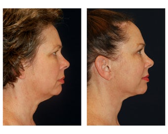 Facial Rejuvenation