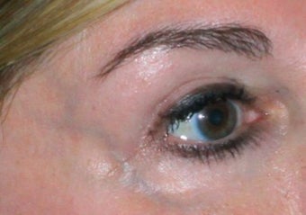 Laser vein removal