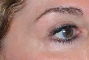 Laser vein removal