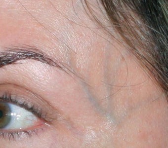 Laser Vein Removal 