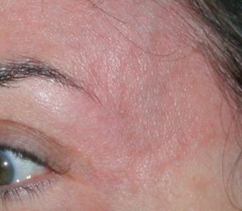 Laser Vein Removal 