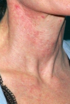 Vbeam laser treatment