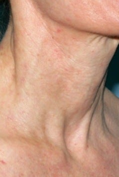 Vbeam laser treatment