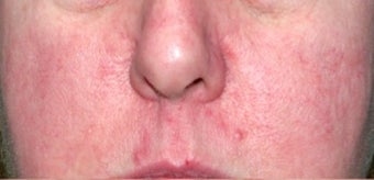 Vbeam for rosacea
