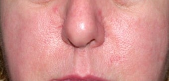 Vbeam for rosacea
