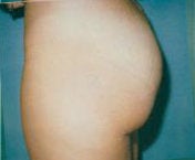 Butt lift