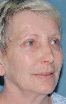 Laser resurfacing treatment for wrinkles
