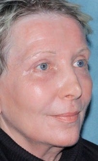 Laser resurfacing treatment for wrinkles