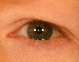 Upper Blepharoplasty (Upper Eyelids)