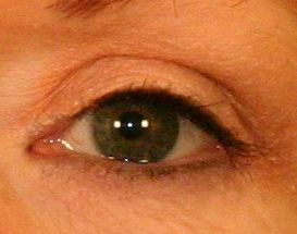 Upper Blepharoplasty (Upper Eyelids)