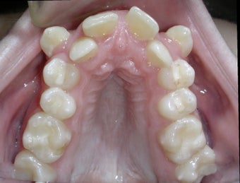 Damon Braces