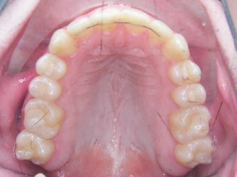 Damon Braces