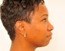 Chin Augmentation
