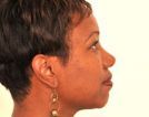 Chin Augmentation