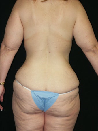 Belt Lipectomy and Breast Lift